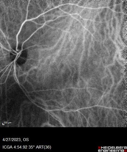 Dome Shaped Macula Left Eye
73 year old female Diagnosed with POHS in the past and treated with laser in the right eye in 1994 with vision loss.  She moved from Tampa to Largo in 2017 and started seeing Dr. Cohen.  She had her last injection in the left eye 2015 prior to moving to Largo.  She has been treated intermittently in the left eye and has been resistant to Anti-VEGF injections.  Her vision is good in the left eye. Images are from April 2023 one month following a Vabysmo injection in the left eye.
PMHx- thyroid disease
Meds: Synthroid
VA 20/200 OD, 20/25 OS
