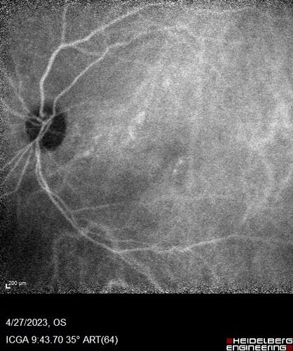 Dome Shaped Macula Left Eye
73 year old female Diagnosed with POHS in the past and treated with laser in the right eye in 1994 with vision loss.  She moved from Tampa to Largo in 2017 and started seeing Dr. Cohen.  She had her last injection in the left eye 2015 prior to moving to Largo.  She has been treated intermittently in the left eye and has been resistant to Anti-VEGF injections.  Her vision is good in the left eye. Images are from April 2023 one month following a Vabysmo injection in the left eye.
PMHx- thyroid disease
Meds: Synthroid
VA 20/200 OD, 20/25 OS
