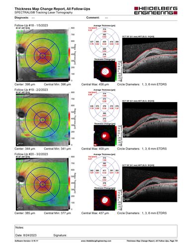 Dome Shaped Macula Left Eye
73 year old female Diagnosed with POHS in the past and treated with laser in the right eye in 1994 with vision loss.  She moved from Tampa to Largo in 2017 and started seeing Dr. Cohen.  She had her last injection in the left eye 2015 prior to moving to Largo.  She has been treated intermittently in the left eye and has been resistant to Anti-VEGF injections.  Her vision is good in the left eye. Images are from April 2023 one month following a Vabysmo injection in the left eye.
PMHx- thyroid disease
Meds: Synthroid
VA 20/200 OD, 20/25 OS
