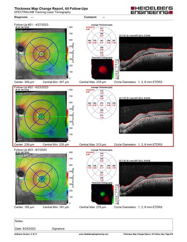 Dome Shaped Macula Left Eye
73 year old female Diagnosed with POHS in the past and treated with laser in the right eye in 1994 with vision loss.  She moved from Tampa to Largo in 2017 and started seeing Dr. Cohen.  She had her last injection in the left eye 2015 prior to moving to Largo.  She has been treated intermittently in the left eye and has been resistant to Anti-VEGF injections.  Her vision is good in the left eye. Images are from April 2023 one month following a Vabysmo injection in the left eye.
PMHx- thyroid disease
Meds: Synthroid
VA 20/200 OD, 20/25 OS
