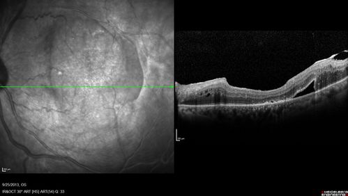 Retained Lens Fragments and Dislocated Intraocular Lens one week following complicated cataract surgery
78 year old female vision is 20/200.  She developed a tear and RD during surgery for the lens fragments and has since developed PVR and had 5 surgeries.  Her vision is now hand motion.
