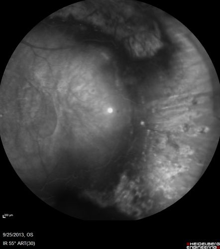 Retained Lens Fragments and Dislocated Intraocular Lens one week following complicated cataract surgery
78 year old female vision is 20/200.  She developed a tear and RD during surgery for the lens fragments and has since developed PVR and had 5 surgeries.  Her vision is now hand motion.
