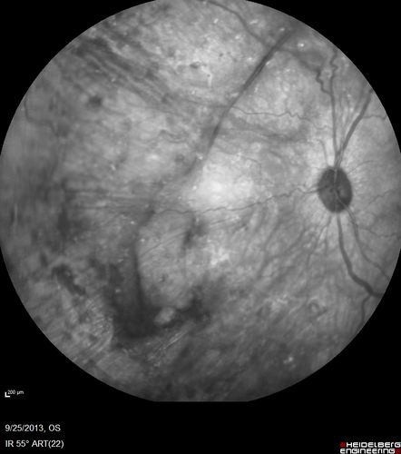 Retained Lens Fragments and Dislocated Intraocular Lens one week following complicated cataract surgery
78 year old female vision is 20/200.  She developed a tear and RD during surgery for the lens fragments and has since developed PVR and had 5 surgeries.  Her vision is now hand motion.
