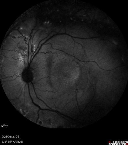 Retained Lens Fragments and Dislocated Intraocular Lens one week following complicated cataract surgery
78 year old female vision is 20/200.  She developed a tear and RD during surgery for the lens fragments and has since developed PVR and had 5 surgeries.  Her vision is now hand motion.
