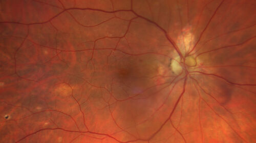 Optic nerve (disc) drusen and choroidal neovascular membrane
85 year old man - The left eye has had poor vision for 7-8 years.Â  The right eye is OK.Â  He was in for a checkup and his ophthalmologist noticed a problem and asked him to see retina doctor.Â Â 
Medical Hx: Cancer. 
Surgical Hx: Back Surgery. Gallbladder. Appendectomy. Colon Cancer.
Systemic Meds: Propafenone Hydrochloride, 225 mg oral tablet. Rosuvastatin. PAROXETINE HCL. GABAPENTIN. DONEPEZIL. Asp
VA OD: Dcc20/25-2 OS: DccCF 1ft 
IOP: TP: OD:13 OS:12
Patient's right eye was treated with Avastin and was dry with one shot.
