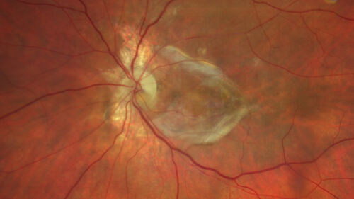 Optic nerve (disc) drusen and choroidal neovascular membrane
85 year old man - The left eye has had poor vision for 7-8 years.Â  The right eye is OK.Â  He was in for a checkup and his ophthalmologist noticed a problem and asked him to see retina doctor.Â Â 
Medical Hx: Cancer. 
Surgical Hx: Back Surgery. Gallbladder. Appendectomy. Colon Cancer.
Systemic Meds: Propafenone Hydrochloride, 225 mg oral tablet. Rosuvastatin. PAROXETINE HCL. GABAPENTIN. DONEPEZIL. Asp
VA OD: Dcc20/25-2 OS: DccCF 1ft 
IOP: TP: OD:13 OS:12
Patient's right eye was treated with Avastin and was dry with one shot.
