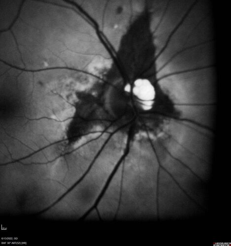 Optic nerve (disc) drusen and choroidal neovascular membrane
85 year old man - The left eye has had poor vision for 7-8 years.Â  The right eye is OK.Â  He was in for a checkup and his ophthalmologist noticed a problem and asked him to see retina doctor.Â Â 
Medical Hx: Cancer. 
Surgical Hx: Back Surgery. Gallbladder. Appendectomy. Colon Cancer.
Systemic Meds: Propafenone Hydrochloride, 225 mg oral tablet. Rosuvastatin. PAROXETINE HCL. GABAPENTIN. DONEPEZIL. Asp
VA OD: Dcc20/25-2 OS: DccCF 1ft 
IOP: TP: OD:13 OS:12
Patient's right eye was treated with Avastin and was dry with one shot.
