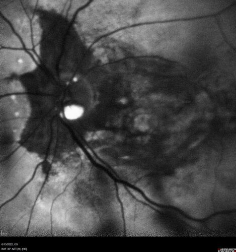 Optic nerve (disc) drusen and choroidal neovascular membrane
85 year old man - The left eye has had poor vision for 7-8 years.Â  The right eye is OK.Â  He was in for a checkup and his ophthalmologist noticed a problem and asked him to see retina doctor.Â Â 
Medical Hx: Cancer. 
Surgical Hx: Back Surgery. Gallbladder. Appendectomy. Colon Cancer.
Systemic Meds: Propafenone Hydrochloride, 225 mg oral tablet. Rosuvastatin. PAROXETINE HCL. GABAPENTIN. DONEPEZIL. Asp
VA OD: Dcc20/25-2 OS: DccCF 1ft 
IOP: TP: OD:13 OS:12
Patient's right eye was treated with Avastin and was dry with one shot.
