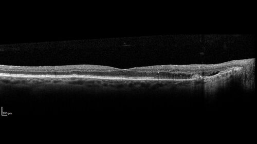 Optic nerve (disc) drusen and choroidal neovascular membrane
85 year old man - The left eye has had poor vision for 7-8 years.Â  The right eye is OK.Â  He was in for a checkup and his ophthalmologist noticed a problem and asked him to see retina doctor.Â Â 
Medical Hx: Cancer. 
Surgical Hx: Back Surgery. Gallbladder. Appendectomy. Colon Cancer.
Systemic Meds: Propafenone Hydrochloride, 225 mg oral tablet. Rosuvastatin. PAROXETINE HCL. GABAPENTIN. DONEPEZIL. Asp
VA OD: Dcc20/25-2 OS: DccCF 1ft 
IOP: TP: OD:13 OS:12
Patient's right eye was treated with Avastin and was dry with one shot.
