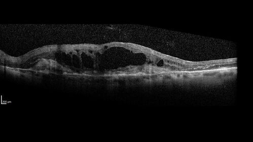 Optic nerve (disc) drusen and choroidal neovascular membrane
85 year old man - The left eye has had poor vision for 7-8 years.Â  The right eye is OK.Â  He was in for a checkup and his ophthalmologist noticed a problem and asked him to see retina doctor.Â Â 
Medical Hx: Cancer. 
Surgical Hx: Back Surgery. Gallbladder. Appendectomy. Colon Cancer.
Systemic Meds: Propafenone Hydrochloride, 225 mg oral tablet. Rosuvastatin. PAROXETINE HCL. GABAPENTIN. DONEPEZIL. Asp
VA OD: Dcc20/25-2 OS: DccCF 1ft 
IOP: TP: OD:13 OS:12
Patient's right eye was treated with Avastin and was dry with one shot.
