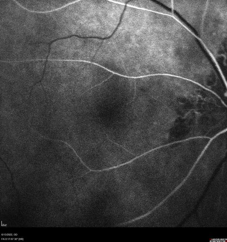 Optic nerve (disc) drusen and choroidal neovascular membrane
85 year old man - The left eye has had poor vision for 7-8 years.Â  The right eye is OK.Â  He was in for a checkup and his ophthalmologist noticed a problem and asked him to see retina doctor.Â Â 
Medical Hx: Cancer. 
Surgical Hx: Back Surgery. Gallbladder. Appendectomy. Colon Cancer.
Systemic Meds: Propafenone Hydrochloride, 225 mg oral tablet. Rosuvastatin. PAROXETINE HCL. GABAPENTIN. DONEPEZIL. Asp
VA OD: Dcc20/25-2 OS: DccCF 1ft 
IOP: TP: OD:13 OS:12
Patient's right eye was treated with Avastin and was dry with one shot.
