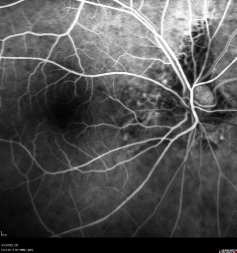 Optic nerve (disc) drusen and choroidal neovascular membrane
85 year old man - The left eye has had poor vision for 7-8 years.Â  The right eye is OK.Â  He was in for a checkup and his ophthalmologist noticed a problem and asked him to see retina doctor.Â Â 
Medical Hx: Cancer. 
Surgical Hx: Back Surgery. Gallbladder. Appendectomy. Colon Cancer.
Systemic Meds: Propafenone Hydrochloride, 225 mg oral tablet. Rosuvastatin. PAROXETINE HCL. GABAPENTIN. DONEPEZIL. Asp
VA OD: Dcc20/25-2 OS: DccCF 1ft 
IOP: TP: OD:13 OS:12
Patient's right eye was treated with Avastin and was dry with one shot.
