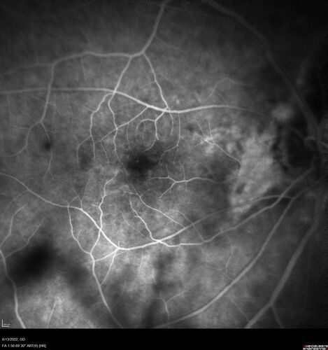 Optic nerve (disc) drusen and choroidal neovascular membrane
85 year old man - The left eye has had poor vision for 7-8 years.Â  The right eye is OK.Â  He was in for a checkup and his ophthalmologist noticed a problem and asked him to see retina doctor.Â Â 
Medical Hx: Cancer. 
Surgical Hx: Back Surgery. Gallbladder. Appendectomy. Colon Cancer.
Systemic Meds: Propafenone Hydrochloride, 225 mg oral tablet. Rosuvastatin. PAROXETINE HCL. GABAPENTIN. DONEPEZIL. Asp
VA OD: Dcc20/25-2 OS: DccCF 1ft 
IOP: TP: OD:13 OS:12
Patient's right eye was treated with Avastin and was dry with one shot.
