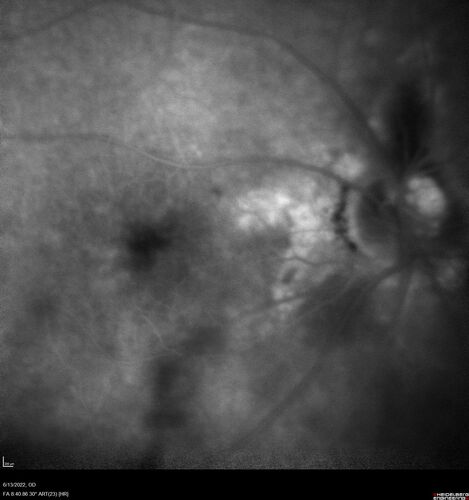 Optic nerve (disc) drusen and choroidal neovascular membrane
85 year old man - The left eye has had poor vision for 7-8 years.Â  The right eye is OK.Â  He was in for a checkup and his ophthalmologist noticed a problem and asked him to see retina doctor.Â Â 
Medical Hx: Cancer. 
Surgical Hx: Back Surgery. Gallbladder. Appendectomy. Colon Cancer.
Systemic Meds: Propafenone Hydrochloride, 225 mg oral tablet. Rosuvastatin. PAROXETINE HCL. GABAPENTIN. DONEPEZIL. Asp
VA OD: Dcc20/25-2 OS: DccCF 1ft 
IOP: TP: OD:13 OS:12
Patient's right eye was treated with Avastin and was dry with one shot.
