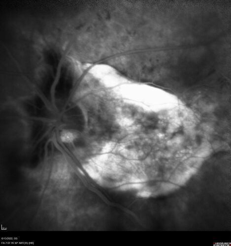 Optic nerve (disc) drusen and choroidal neovascular membrane
85 year old man - The left eye has had poor vision for 7-8 years.Â  The right eye is OK.Â  He was in for a checkup and his ophthalmologist noticed a problem and asked him to see retina doctor.Â Â 
Medical Hx: Cancer. 
Surgical Hx: Back Surgery. Gallbladder. Appendectomy. Colon Cancer.
Systemic Meds: Propafenone Hydrochloride, 225 mg oral tablet. Rosuvastatin. PAROXETINE HCL. GABAPENTIN. DONEPEZIL. Asp
VA OD: Dcc20/25-2 OS: DccCF 1ft 
IOP: TP: OD:13 OS:12
Patient's right eye was treated with Avastin and was dry with one shot.
