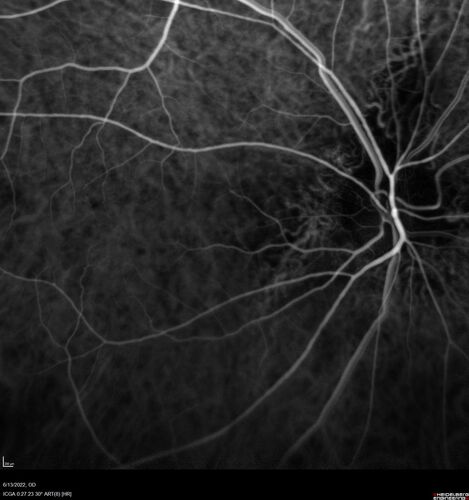 Optic nerve (disc) drusen and choroidal neovascular membrane
85 year old man - The left eye has had poor vision for 7-8 years.Â  The right eye is OK.Â  He was in for a checkup and his ophthalmologist noticed a problem and asked him to see retina doctor.Â Â 
Medical Hx: Cancer. 
Surgical Hx: Back Surgery. Gallbladder. Appendectomy. Colon Cancer.
Systemic Meds: Propafenone Hydrochloride, 225 mg oral tablet. Rosuvastatin. PAROXETINE HCL. GABAPENTIN. DONEPEZIL. Asp
VA OD: Dcc20/25-2 OS: DccCF 1ft 
IOP: TP: OD:13 OS:12
Patient's right eye was treated with Avastin and was dry with one shot.
