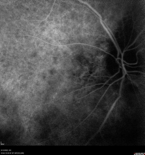 Optic nerve (disc) drusen and choroidal neovascular membrane
85 year old man - The left eye has had poor vision for 7-8 years.Â  The right eye is OK.Â  He was in for a checkup and his ophthalmologist noticed a problem and asked him to see retina doctor.Â Â 
Medical Hx: Cancer. 
Surgical Hx: Back Surgery. Gallbladder. Appendectomy. Colon Cancer.
Systemic Meds: Propafenone Hydrochloride, 225 mg oral tablet. Rosuvastatin. PAROXETINE HCL. GABAPENTIN. DONEPEZIL. Asp
VA OD: Dcc20/25-2 OS: DccCF 1ft 
IOP: TP: OD:13 OS:12
Patient's right eye was treated with Avastin and was dry with one shot.
