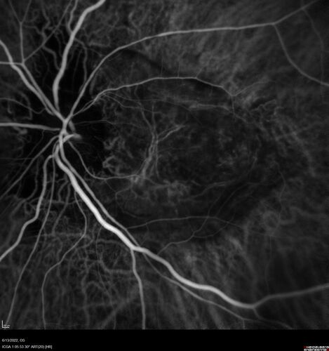 Optic nerve (disc) drusen and choroidal neovascular membrane
85 year old man - The left eye has had poor vision for 7-8 years.Â  The right eye is OK.Â  He was in for a checkup and his ophthalmologist noticed a problem and asked him to see retina doctor.Â Â 
Medical Hx: Cancer. 
Surgical Hx: Back Surgery. Gallbladder. Appendectomy. Colon Cancer.
Systemic Meds: Propafenone Hydrochloride, 225 mg oral tablet. Rosuvastatin. PAROXETINE HCL. GABAPENTIN. DONEPEZIL. Asp
VA OD: Dcc20/25-2 OS: DccCF 1ft 
IOP: TP: OD:13 OS:12
Patient's right eye was treated with Avastin and was dry with one shot.

