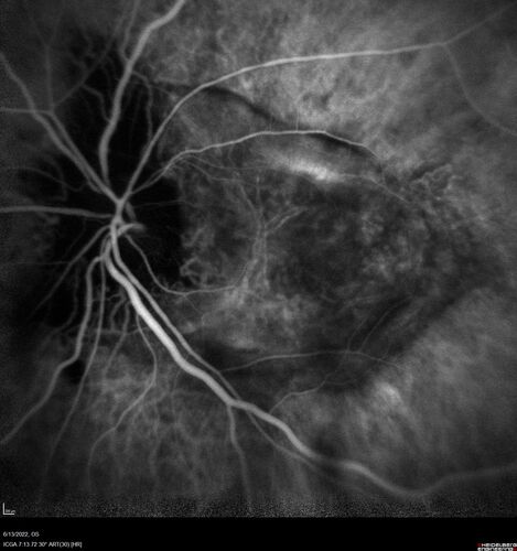 Optic nerve (disc) drusen and choroidal neovascular membrane
85 year old man - The left eye has had poor vision for 7-8 years.Â  The right eye is OK.Â  He was in for a checkup and his ophthalmologist noticed a problem and asked him to see retina doctor.Â Â 
Medical Hx: Cancer. 
Surgical Hx: Back Surgery. Gallbladder. Appendectomy. Colon Cancer.
Systemic Meds: Propafenone Hydrochloride, 225 mg oral tablet. Rosuvastatin. PAROXETINE HCL. GABAPENTIN. DONEPEZIL. Asp
VA OD: Dcc20/25-2 OS: DccCF 1ft 
IOP: TP: OD:13 OS:12
Patient's right eye was treated with Avastin and was dry with one shot.
