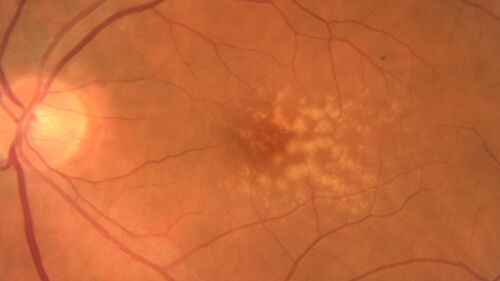 Large and Extensive Macular Drusen
64 year old female with 20/25 vision taking vitamins in for a checkup.
