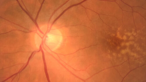 Large and Extensive Macular Drusen
64 year old female with 20/25 vision taking vitamins in for a checkup.
