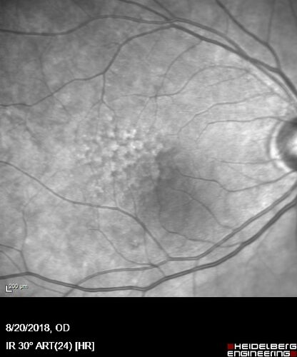 Large and Extensive Macular Drusen
64 year old female with 20/25 vision taking vitamins in for a checkup.

