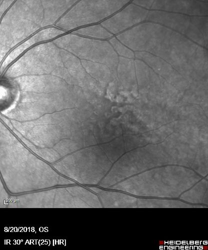 Large and Extensive Macular Drusen
64 year old female with 20/25 vision taking vitamins in for a checkup.
