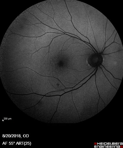 Large and Extensive Macular Drusen
64 year old female with 20/25 vision taking vitamins in for a checkup.
