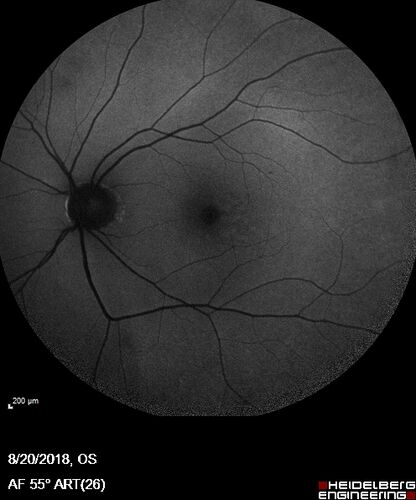 Large and Extensive Macular Drusen
64 year old female with 20/25 vision taking vitamins in for a checkup.
