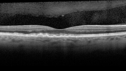 Large and Extensive Macular Drusen
64 year old female with 20/25 vision taking vitamins in for a checkup.
