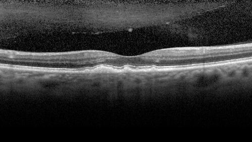 Large and Extensive Macular Drusen
64 year old female with 20/25 vision taking vitamins in for a checkup.

