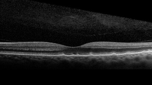 Large and Extensive Macular Drusen
64 year old female with 20/25 vision taking vitamins in for a checkup.
