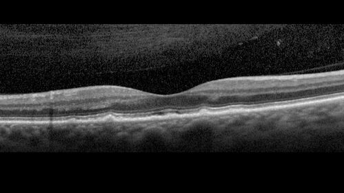 Large and Extensive Macular Drusen
64 year old female with 20/25 vision taking vitamins in for a checkup.
