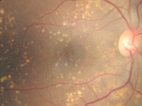Drusen Maculopathy - Macular Degeneration (Dry) - 50 year old African-American Woman
50-year-old woman has drusen and maculopathy.  VISUAL ACUITY:  OD 20/30,  OS 20/25.  
