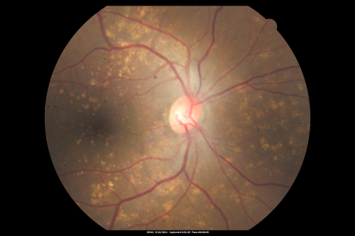 Drusen Maculopathy - Macular Degeneration (Dry) - 50 year old African-American Woman
50-year-old woman has drusen and maculopathy.  VISUAL ACUITY:  OD 20/30,  OS 20/25.  
