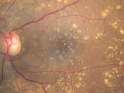 Drusen Maculopathy - Macular Degeneration (Dry) - 50 year old African-American Woman
50-year-old woman has drusen and maculopathy.  VISUAL ACUITY:  OD 20/30,  OS 20/25.  
