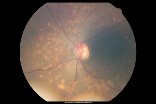 Drusen Maculopathy - Macular Degeneration (Dry) - 50 year old African-American Woman
50-year-old woman has drusen and maculopathy.  VISUAL ACUITY:  OD 20/30,  OS 20/25.  
