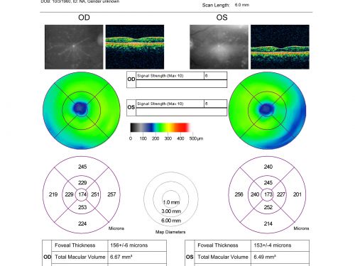 Drusen Maculopathy - Macular Degeneration (Dry) - 50 year old African-American Woman
50-year-old woman has drusen and maculopathy.  VISUAL ACUITY:  OD 20/30,  OS 20/25.  

