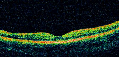 Basal Laminar Drusen - Cuticular Drusen - 19 Year Old with Lupus Nephritis
19-year-old.  She has a history of developing severe systemic lupus erythematosus in 2001.  She was in renal failure and had biopsy proven Class 2 lupus nephritis.  She is currently on Plaquenil 400 mg for six years, as well as Prednisolone orally, every other day. OD 20/20, OS 20/25.
Keywords: Basal Laminar Drusen;Cuticular Drusen