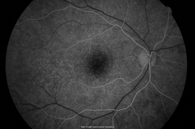 Basal Laminar Drusen - Cuticular Drusen - 19 Year Old with Lupus Nephritis
19-year-old.  She has a history of developing severe systemic lupus erythematosus in 2001.  She was in renal failure and had biopsy proven Class 2 lupus nephritis.  She is currently on Plaquenil 400 mg for six years, as well as Prednisolone orally, every other day. OD 20/20, OS 20/25.
Keywords: Basal Laminar Drusen;Cuticular Drusen