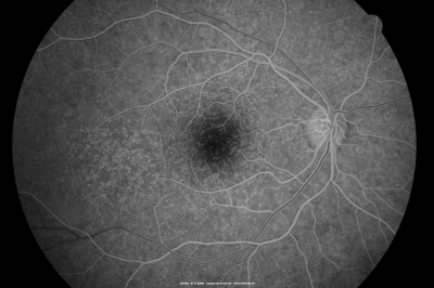 Basal Laminar Drusen - Cuticular Drusen - 19 Year Old with Lupus Nephritis
19-year-old.  She has a history of developing severe systemic lupus erythematosus in 2001.  She was in renal failure and had biopsy proven Class 2 lupus nephritis.  She is currently on Plaquenil 400 mg for six years, as well as Prednisolone orally, every other day. OD 20/20, OS 20/25.
Keywords: Basal Laminar Drusen;Cuticular Drusen