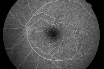 Basal Laminar Drusen - Cuticular Drusen - 19 Year Old with Lupus Nephritis
19-year-old.  She has a history of developing severe systemic lupus erythematosus in 2001.  She was in renal failure and had biopsy proven Class 2 lupus nephritis.  She is currently on Plaquenil 400 mg for six years, as well as Prednisolone orally, every other day. OD 20/20, OS 20/25.
Keywords: Basal Laminar Drusen;Cuticular Drusen