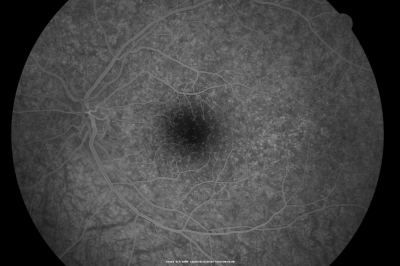 Basal Laminar Drusen - Cuticular Drusen - 19 Year Old with Lupus Nephritis
19-year-old.  She has a history of developing severe systemic lupus erythematosus in 2001.  She was in renal failure and had biopsy proven Class 2 lupus nephritis.  She is currently on Plaquenil 400 mg for six years, as well as Prednisolone orally, every other day. OD 20/20, OS 20/25.
Schlüsselwörter: Basal Laminar Drusen;Cuticular Drusen