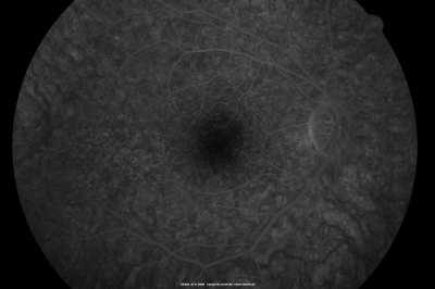 Basal Laminar Drusen - Cuticular Drusen - 19 Year Old with Lupus Nephritis
19-year-old.  She has a history of developing severe systemic lupus erythematosus in 2001.  She was in renal failure and had biopsy proven Class 2 lupus nephritis.  She is currently on Plaquenil 400 mg for six years, as well as Prednisolone orally, every other day. OD 20/20, OS 20/25.
Palabras clave: Basal Laminar Drusen;Cuticular Drusen