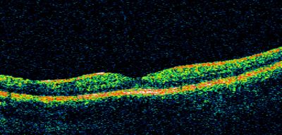 Basal Laminar Drusen - Cuticular Drusen - 19 Year Old with Lupus Nephritis
19-year-old.  She has a history of developing severe systemic lupus erythematosus in 2001.  She was in renal failure and had biopsy proven Class 2 lupus nephritis.  She is currently on Plaquenil 400 mg for six years, as well as Prednisolone orally, every other day. OD 20/20, OS 20/25.
Keywords: Basal Laminar Drusen;Cuticular Drusen