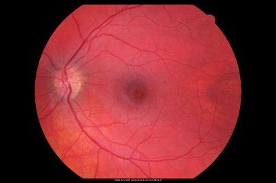 Basal Laminar Drusen - Cuticular Drusen - 19 Year Old with Lupus Nephritis
19-year-old.  She has a history of developing severe systemic lupus erythematosus in 2001.  She was in renal failure and had biopsy proven Class 2 lupus nephritis.  She is currently on Plaquenil 400 mg for six years, as well as Prednisolone orally, every other day. OD 20/20, OS 20/25.
Palabras clave: Basal Laminar Drusen;Cuticular Drusen