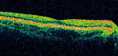 Basal Laminar Drusen - Cuticular Drusen - 19 Year Old with Lupus Nephritis
19-year-old.  She has a history of developing severe systemic lupus erythematosus in 2001.  She was in renal failure and had biopsy proven Class 2 lupus nephritis.  She is currently on Plaquenil 400 mg for six years, as well as Prednisolone orally, every other day. OD 20/20, OS 20/25.
Keywords: Basal Laminar Drusen;Cuticular Drusen