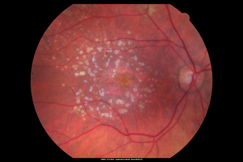 Calcified Macular Drusen - Age Related Macular Degeneration - Dry
74-year-old woman
  OD 20/25,  OS 20/32

