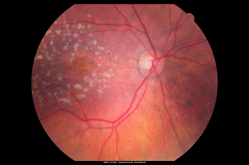 Calcified Macular Drusen - Age Related Macular Degeneration - Dry
74-year-old woman
  OD 20/25,  OS 20/32
