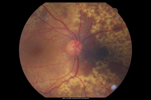 Equatorial Drusen Right Eye
